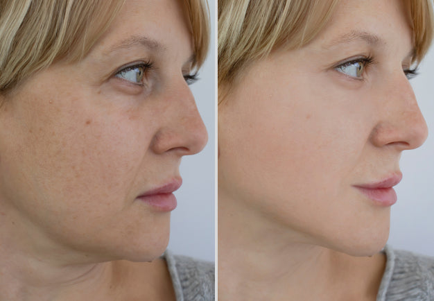 Photo showing face on one day 1 of using the iAura Facial Sculptor and a comparison side by side of her face on day 30 showing improvements to her Double Chin
