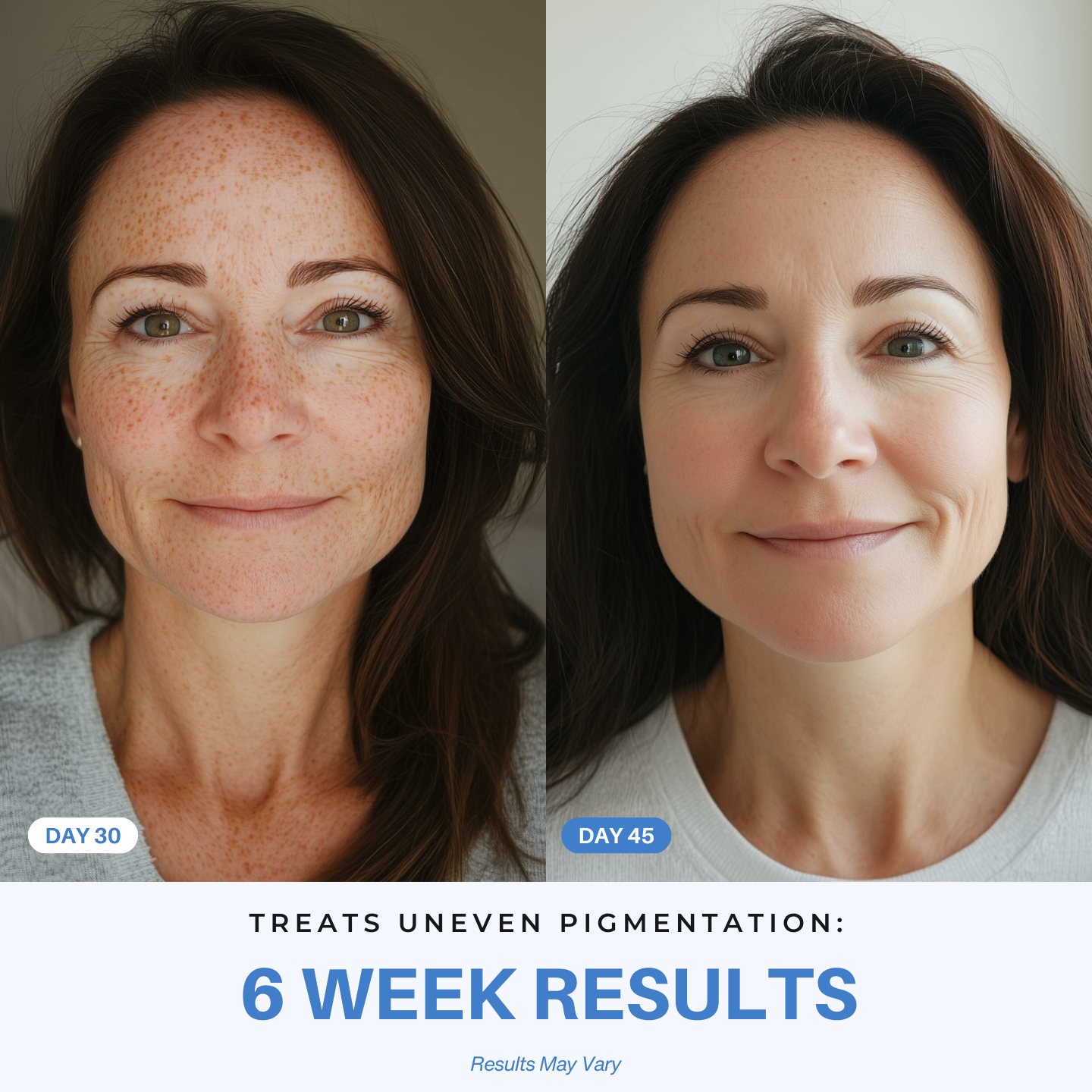 iAura 7-in-1 Radiant Pro Sculptor 6 week results hyperpigmentation