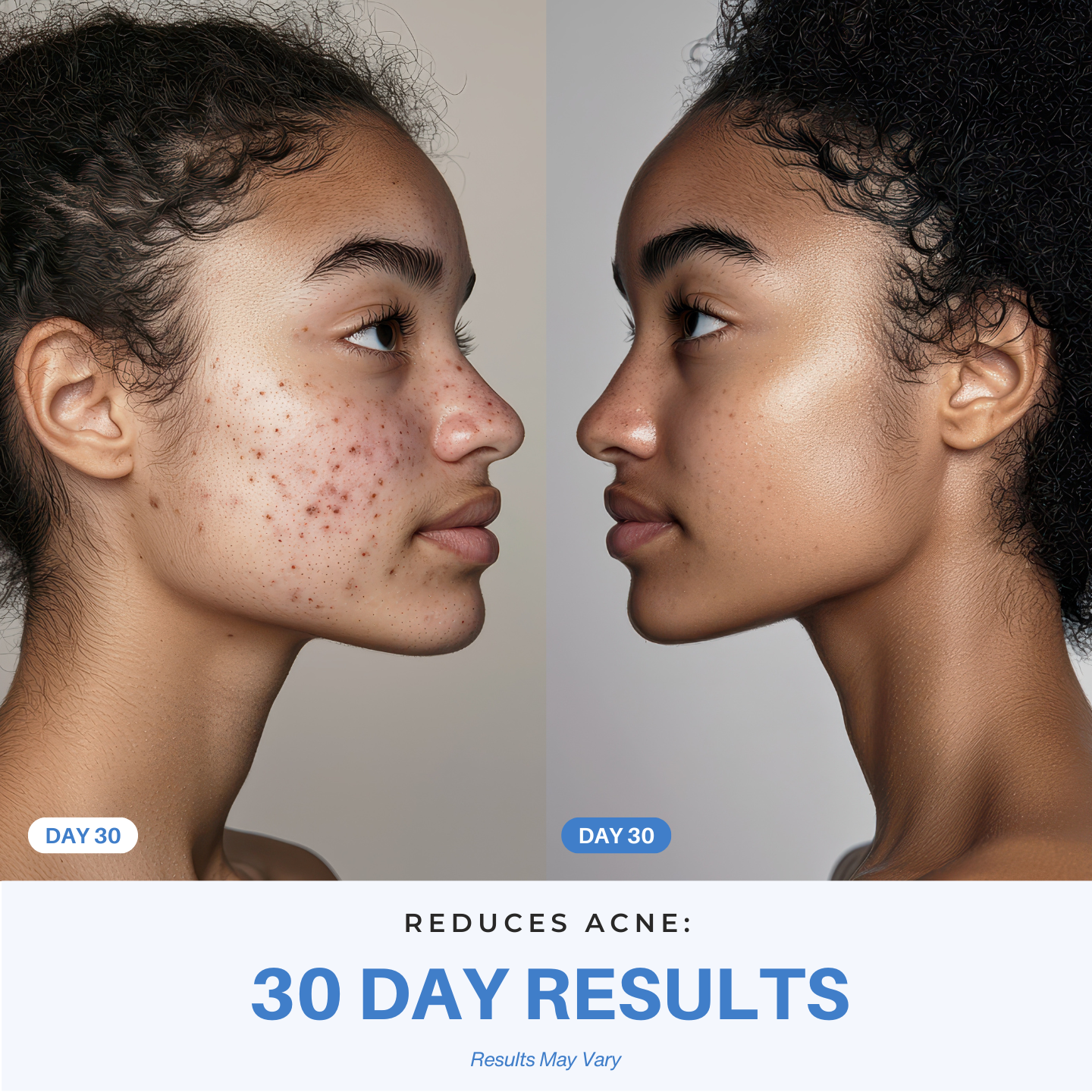 iAura 7-in-1 Radiant Pro Sculptor 30 Day Results ACNE