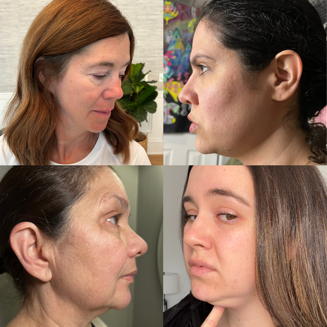 Side profile of a woman showing her dropping chin skin